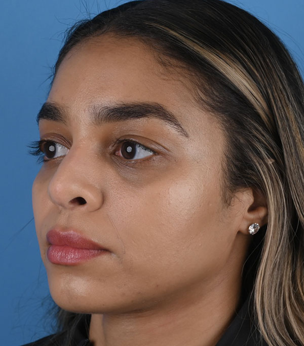 Rhinoplasty