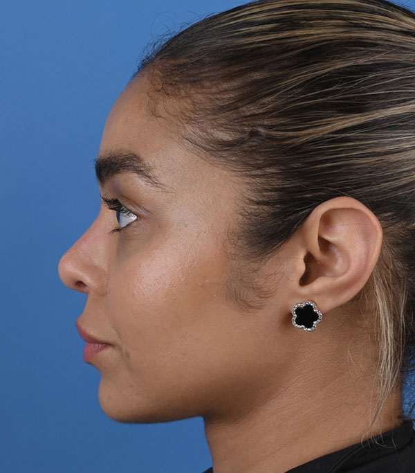 Rhinoplasty