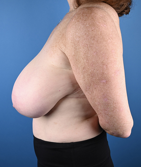 Breast Reduction