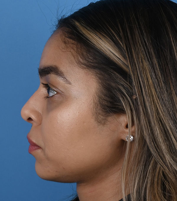 Rhinoplasty