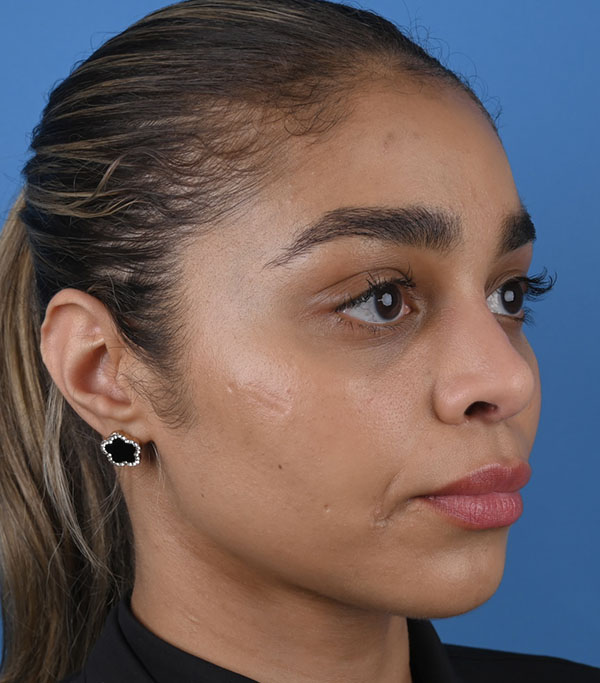 Rhinoplasty