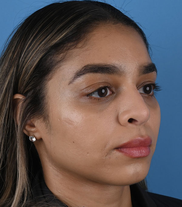 Rhinoplasty