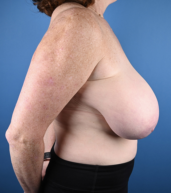 Breast Reduction