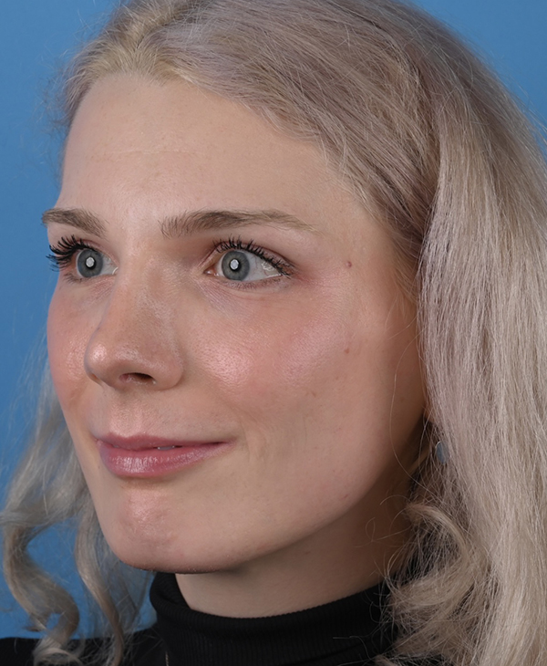 Rhinoplasty