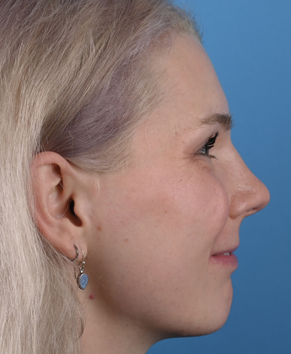 Rhinoplasty