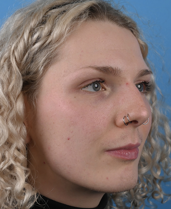 Rhinoplasty