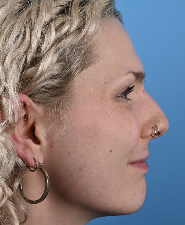 Rhinoplasty