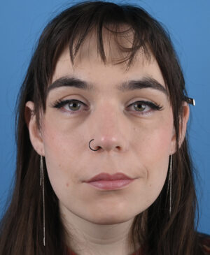 Facial Feminization