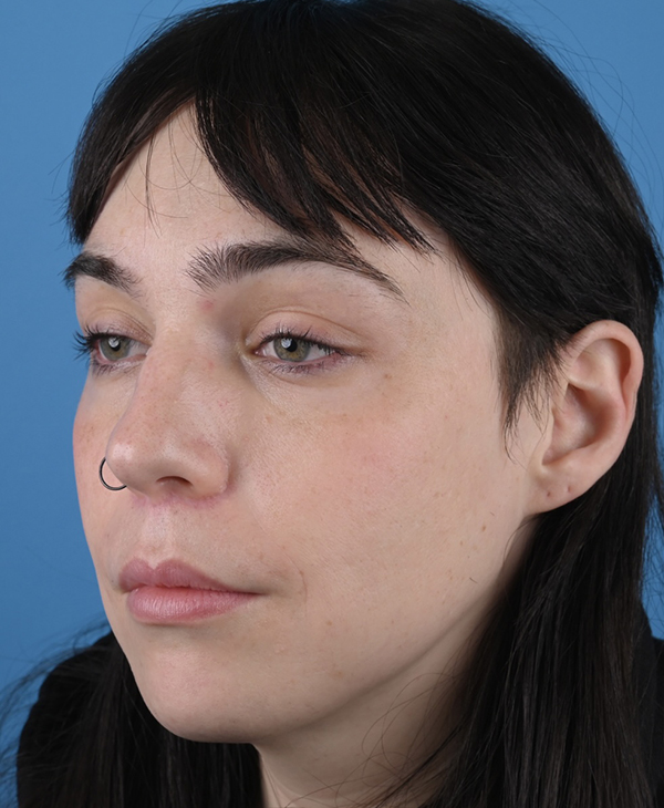 Facial Feminization