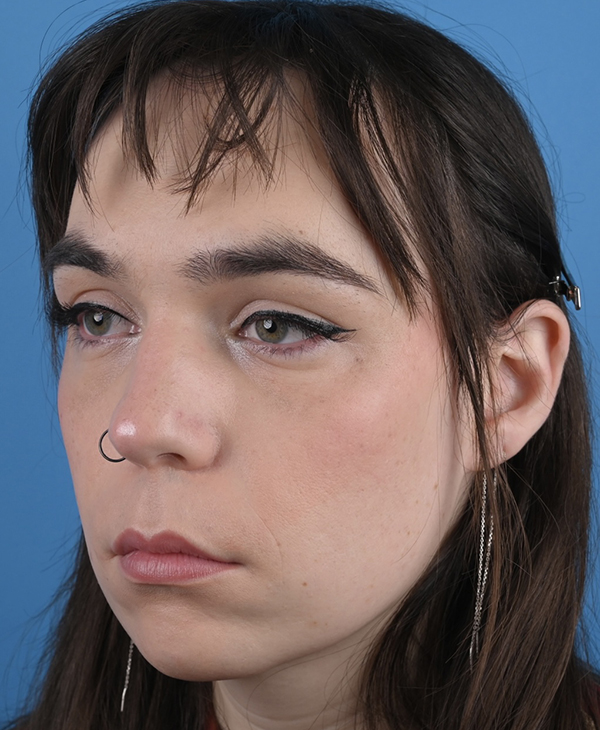 Facial Feminization