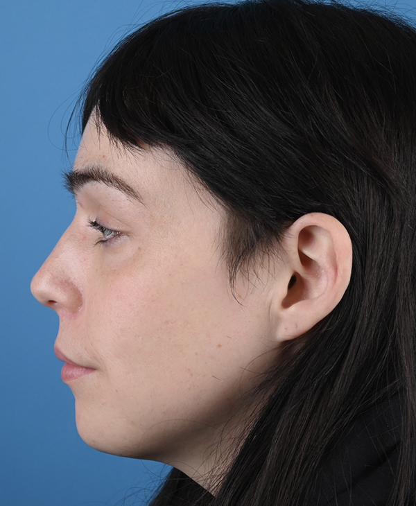 Facial Feminization