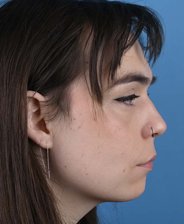 Facial Feminization