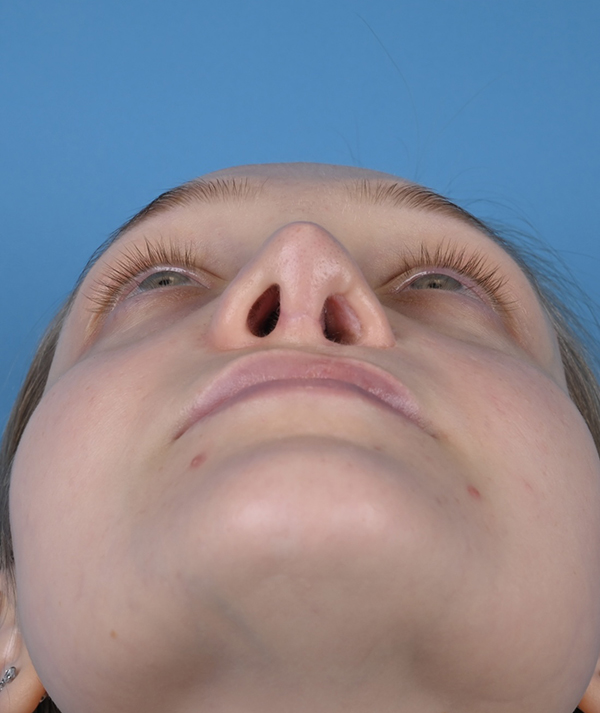 Cleft Rhinoplasty