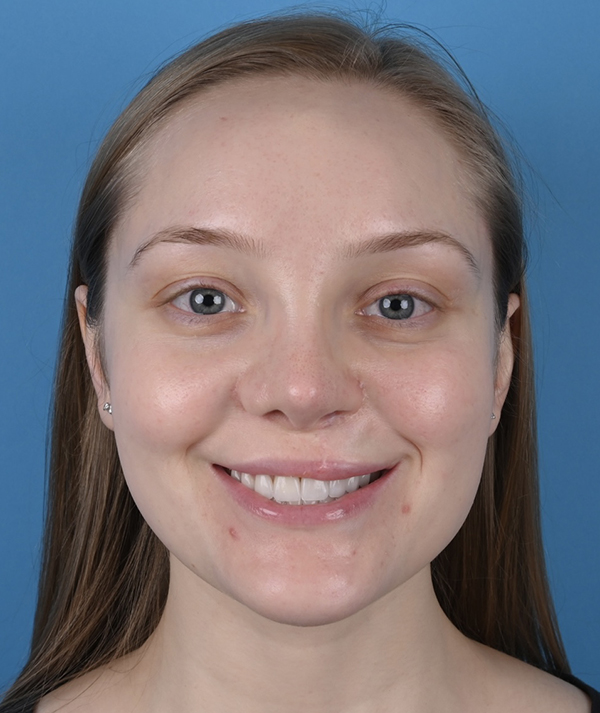 Cleft Rhinoplasty
