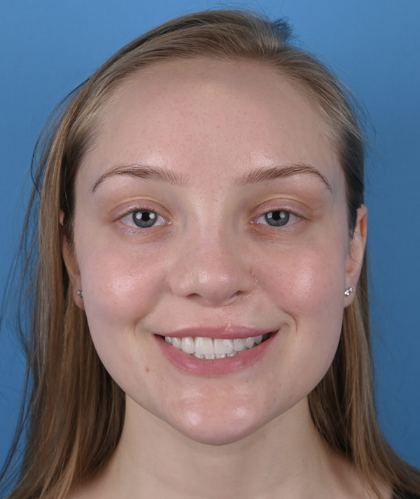 Cleft Rhinoplasty