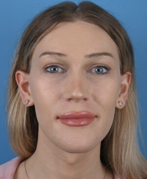 Facial Feminization