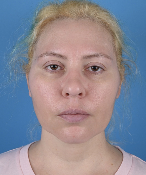 Facelift