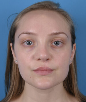 Cleft Rhinoplasty