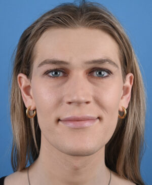 Facial Feminization