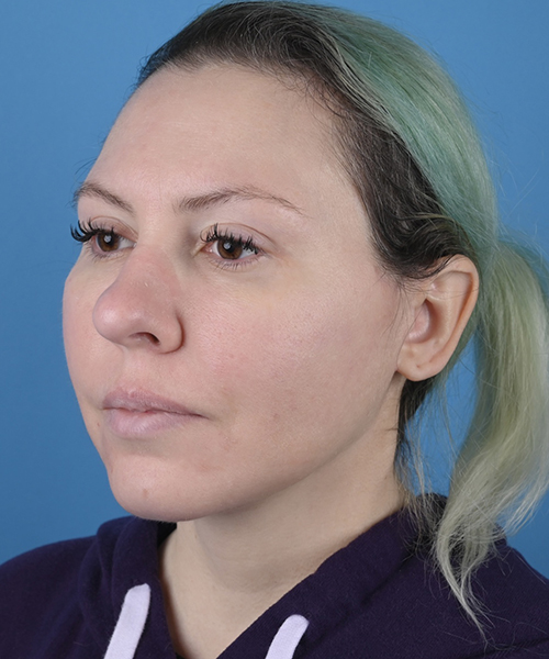 Facelift