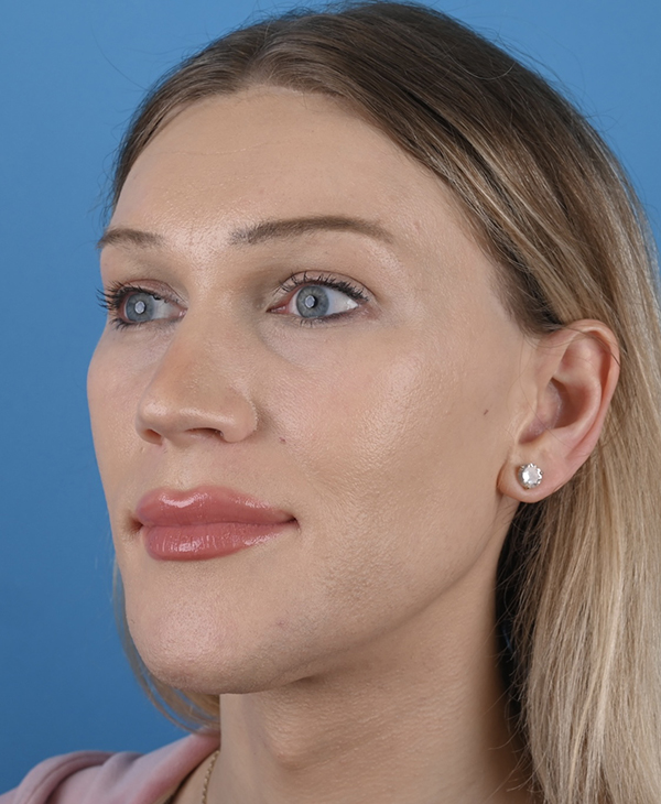 Facial Feminization