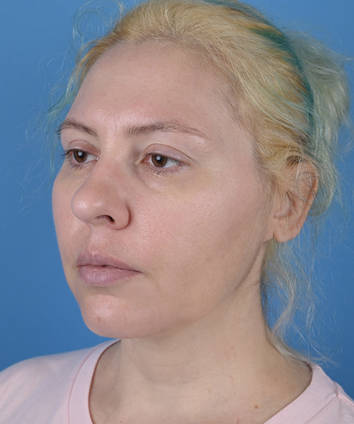 Facelift
