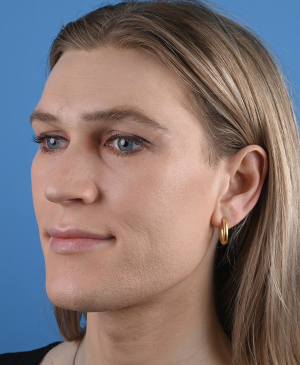Facial Feminization