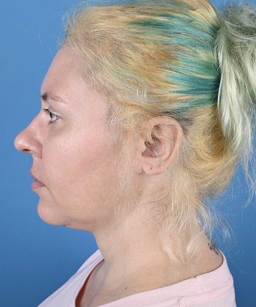 Facelift