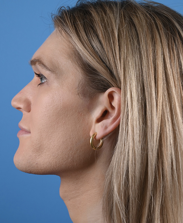 Facial Feminization