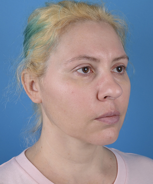 Facelift