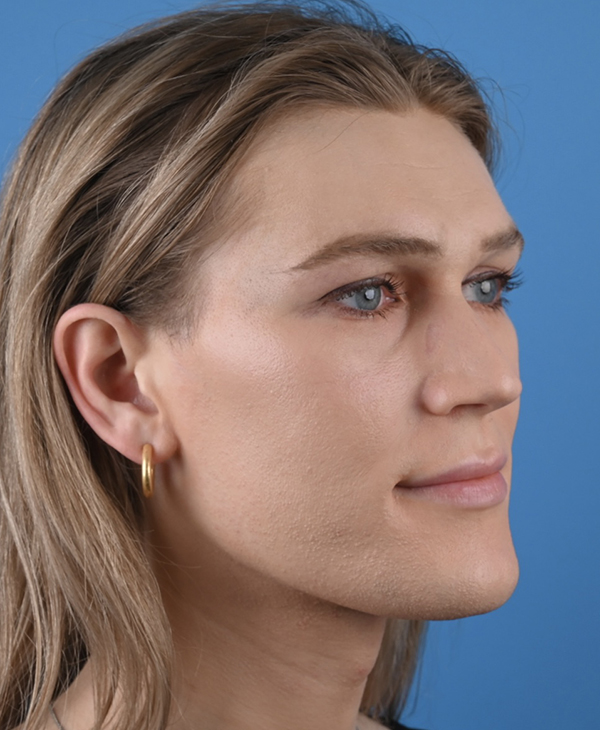 Facial Feminization
