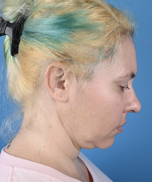 Facelift