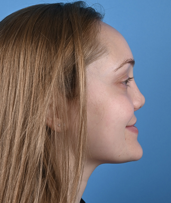 Cleft Rhinoplasty
