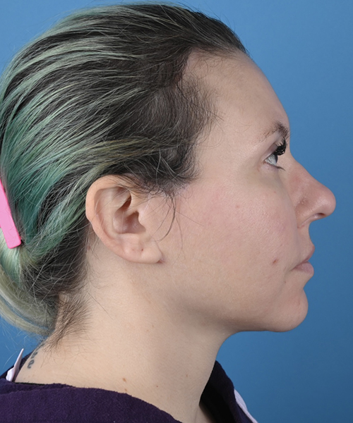 Facelift