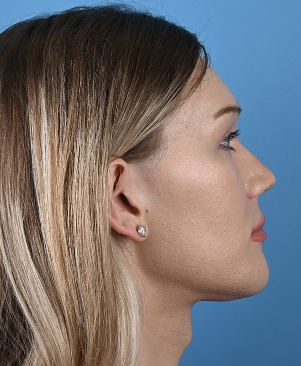 Facial Feminization