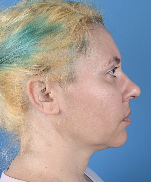 Facelift