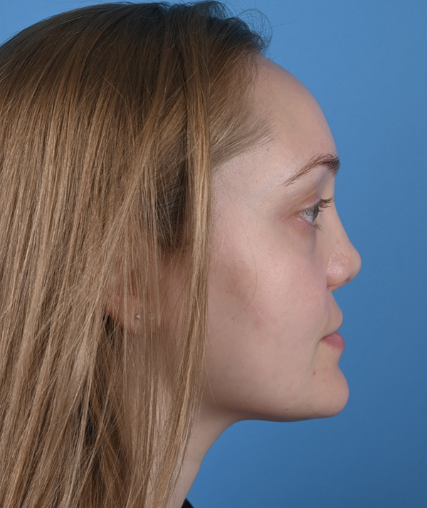 Cleft Rhinoplasty