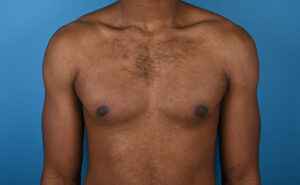 After gynecomastia Front View