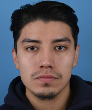 After male rhinoplasty Front View