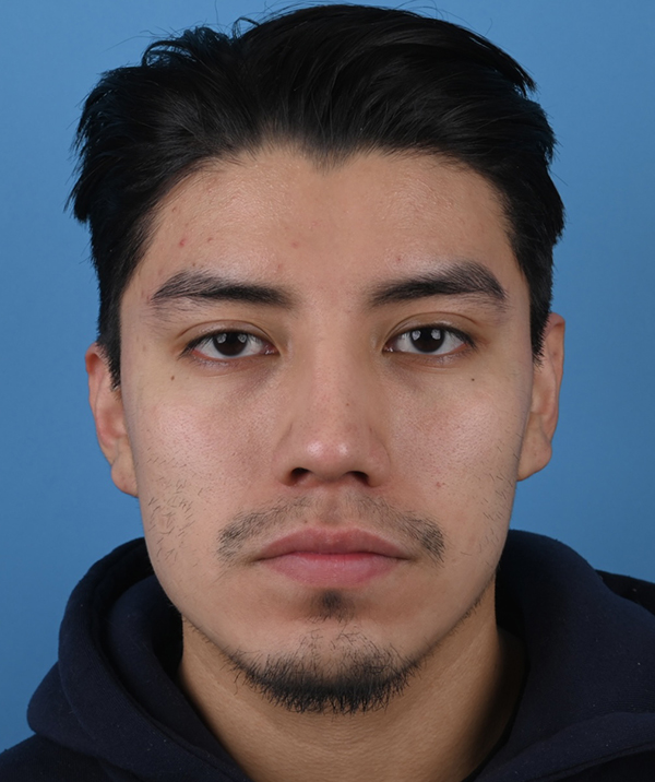Male Rhinoplasty