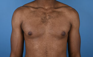 Before gynecomastia Front View