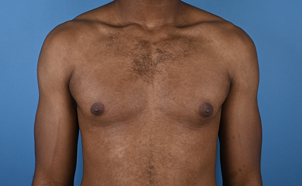 Gynecomastia