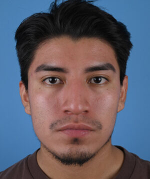 Before male rhinoplasty Front View
