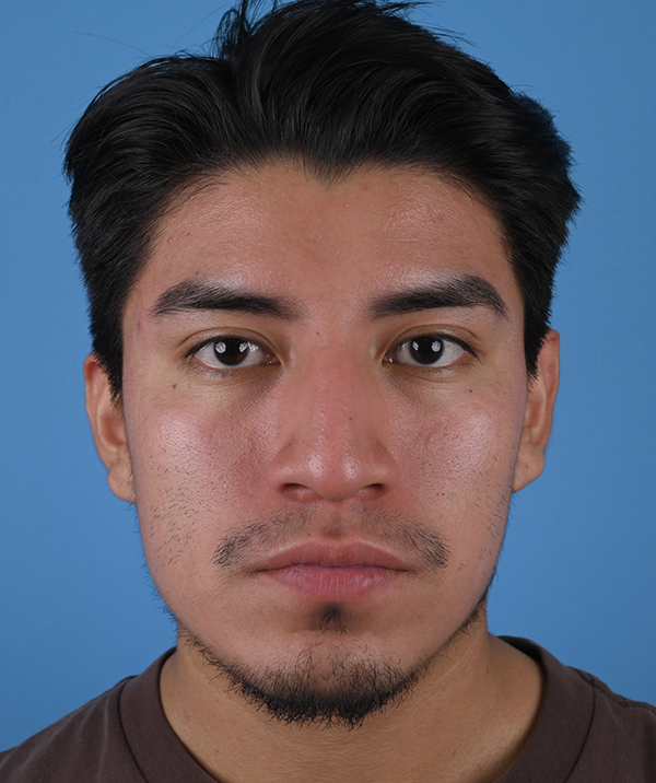 Male Rhinoplasty
