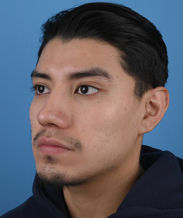 Male Rhinoplasty