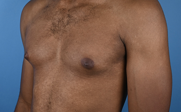 Gynecomastia