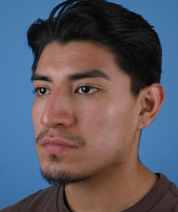 Male Rhinoplasty
