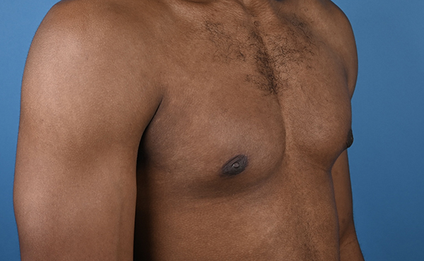 Gynecomastia