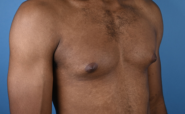 Gynecomastia