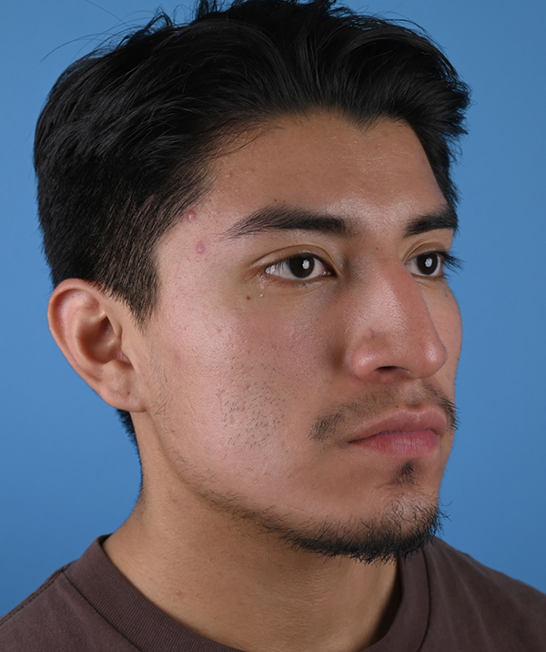 Male Rhinoplasty